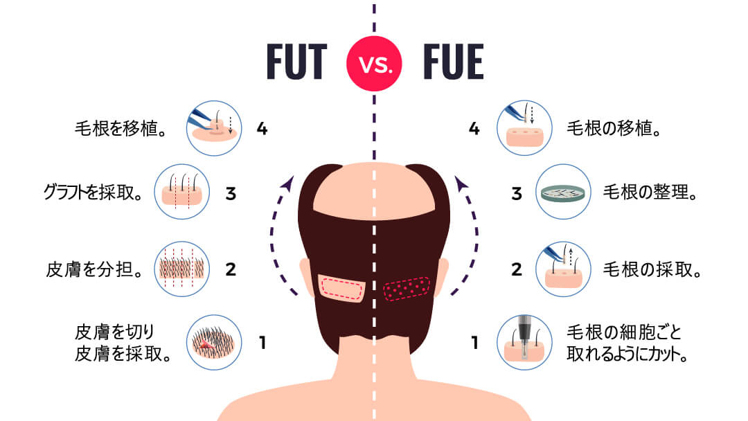 FUE法とFUT法のメリット・デメリット比較