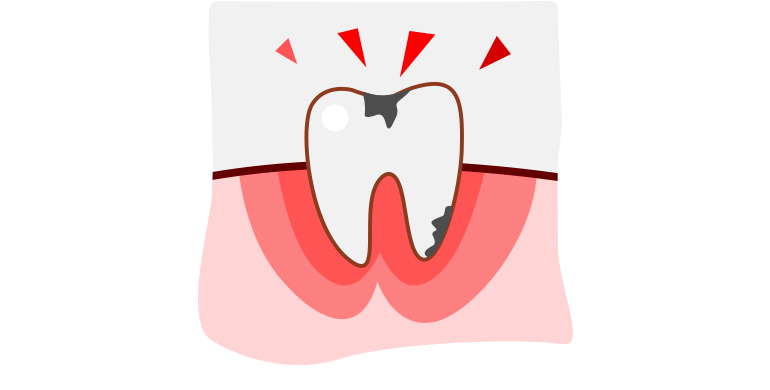 虫歯による脱毛