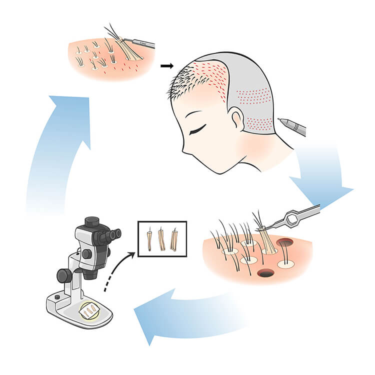 FUE法 自毛植毛・自毛植毛におけるFUE法とは？